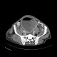 Carcinoma of urinary bladder, invasion into prostate: CT - Computed tomography